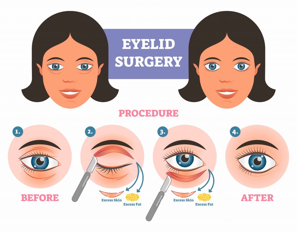 STEPS FOR EYELID SURGERY