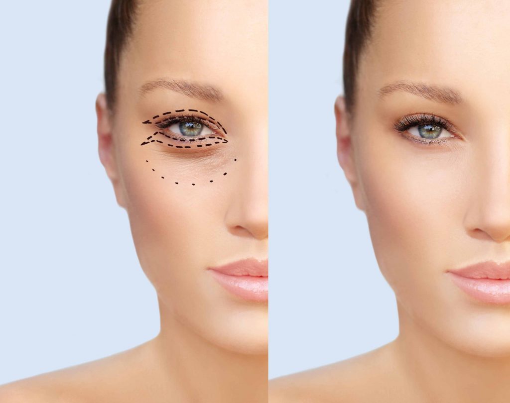 eyelid cosmetic surgery