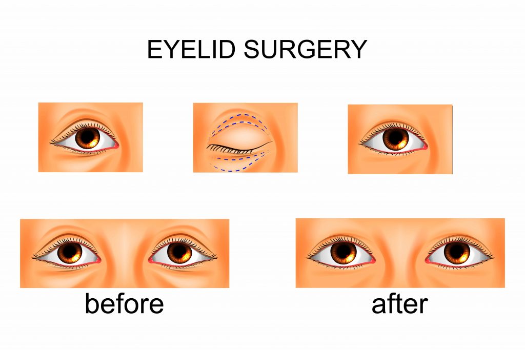 blepharoplasty (eyelid surgery)
