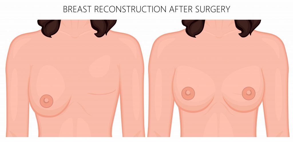 Breast-Reconstruction-1