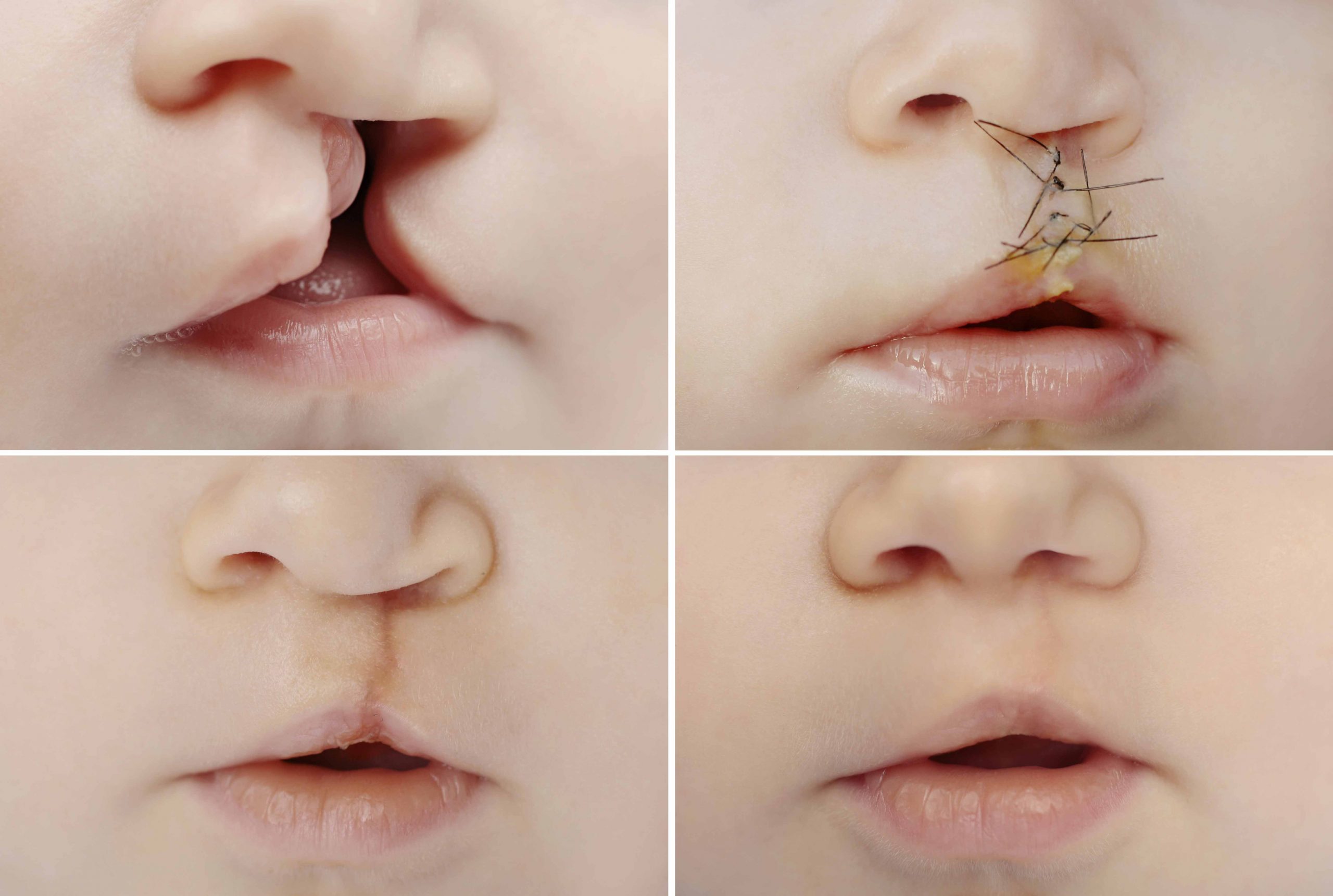 Cleft-Lip-and-Palate-Repair-1