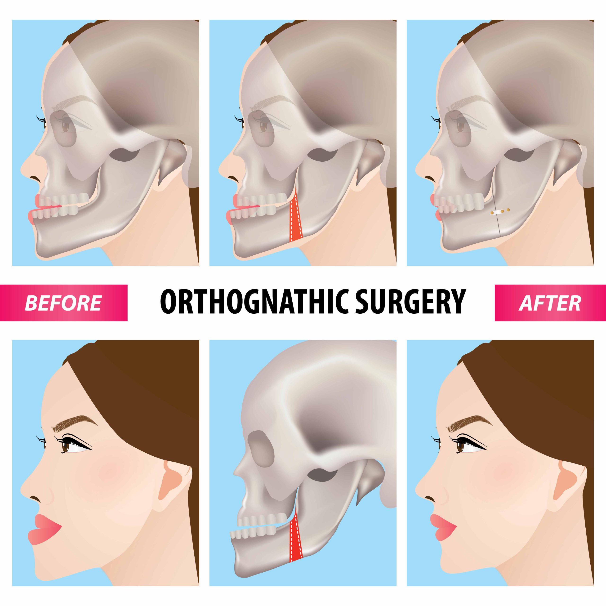 Maxillary Surgery Before And After