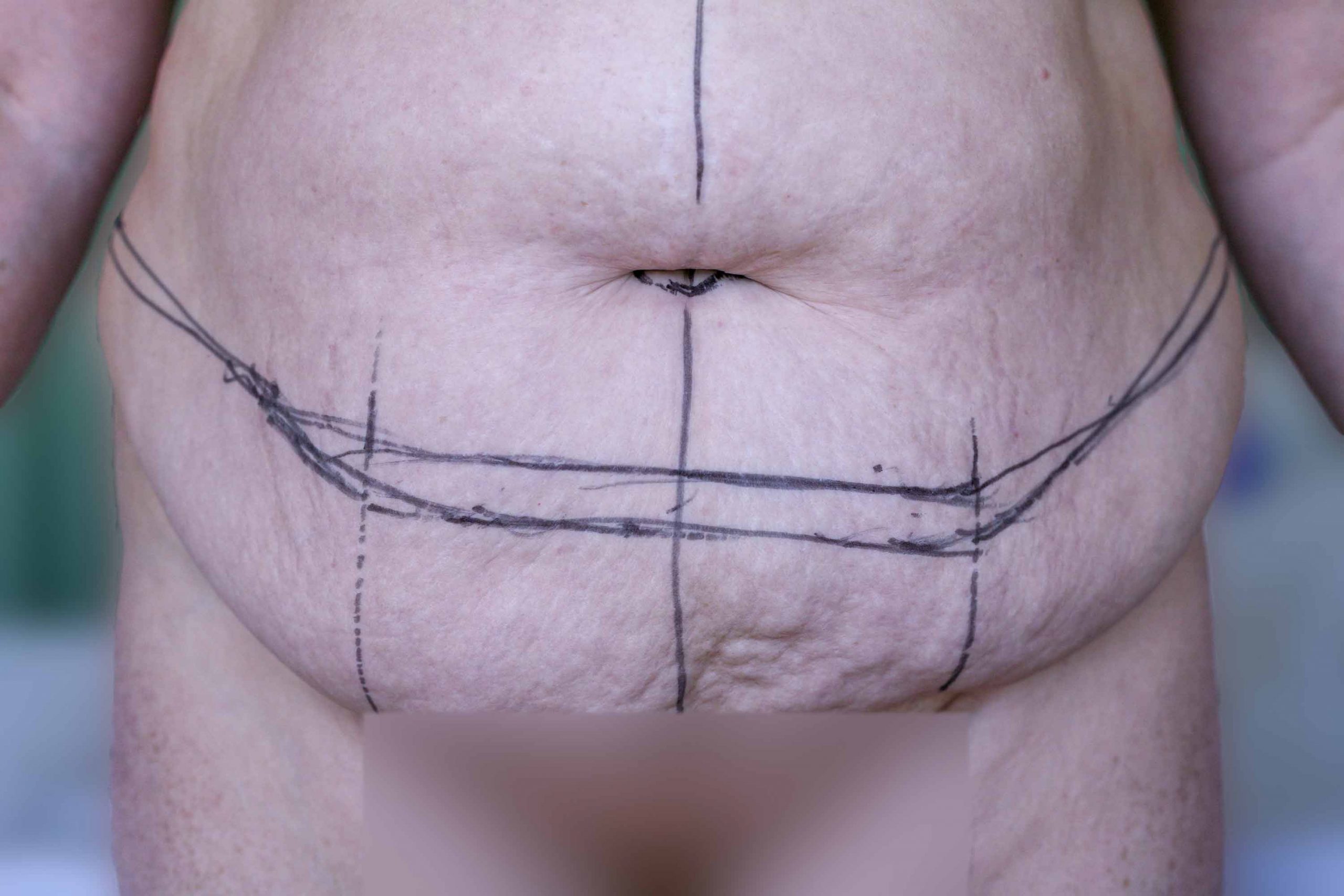 Tummy Tuck vs Panniculectomy