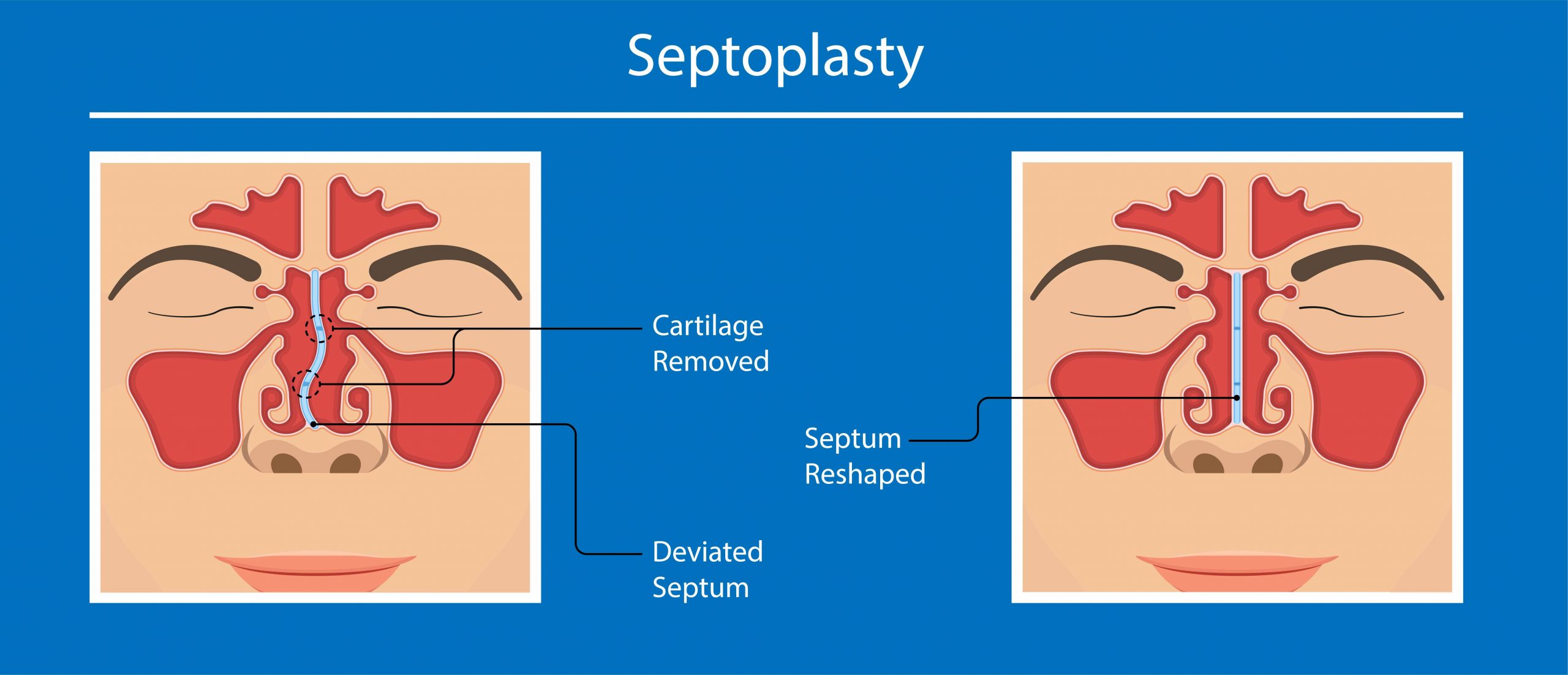Septoplasty-2