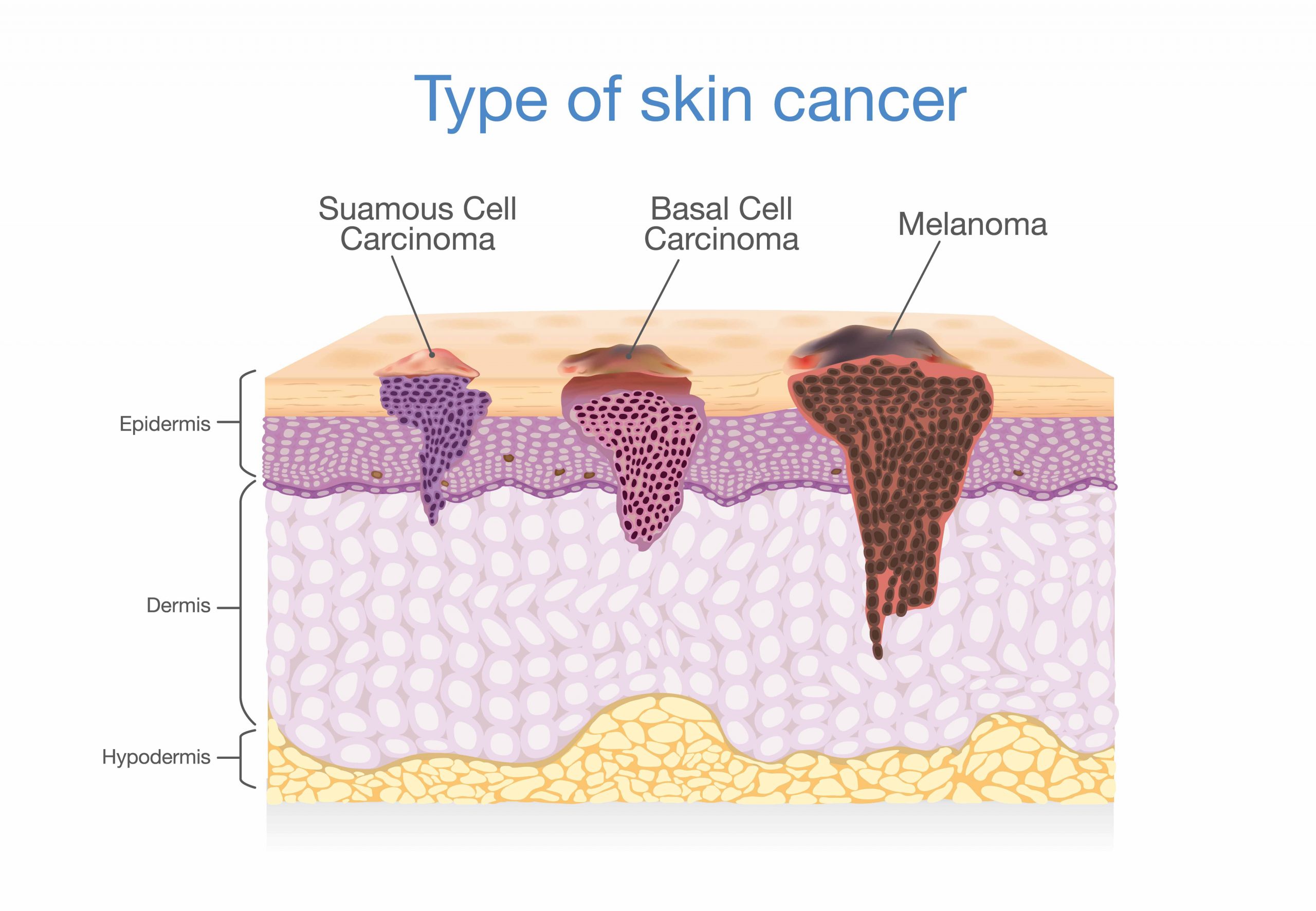 Skin-Cancer-Removal-2