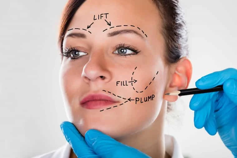 Facelift Surgery