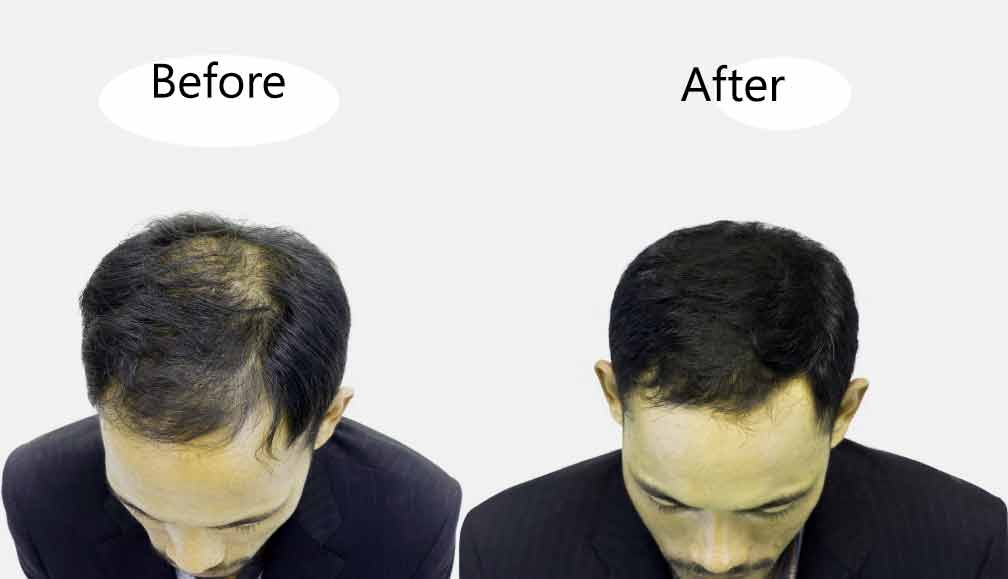 Hair Follicle Transplant | Asli Tarcan Clinic