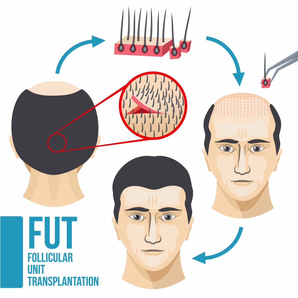 hair transplant fut procedure