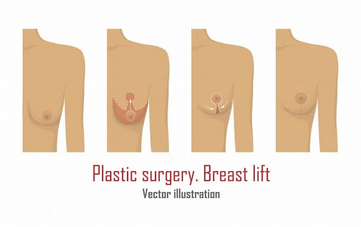 Mastopexy