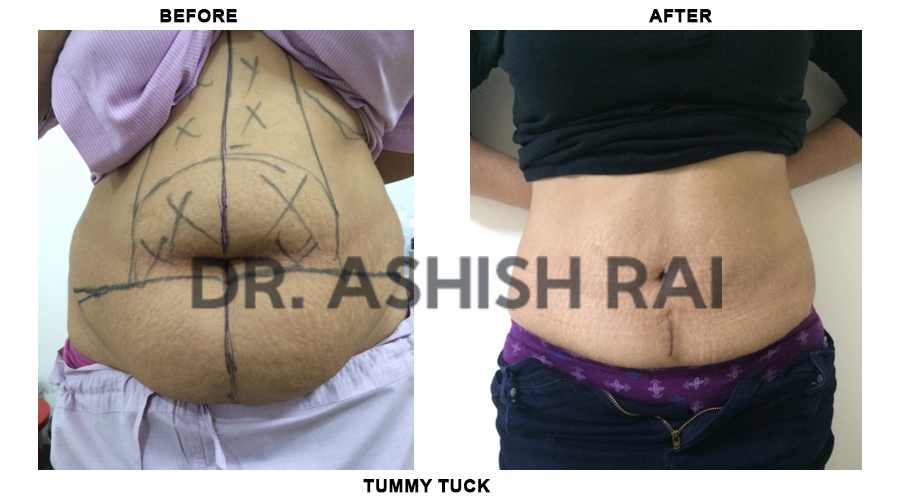 Tummy Tuck - Dr. Ashruf