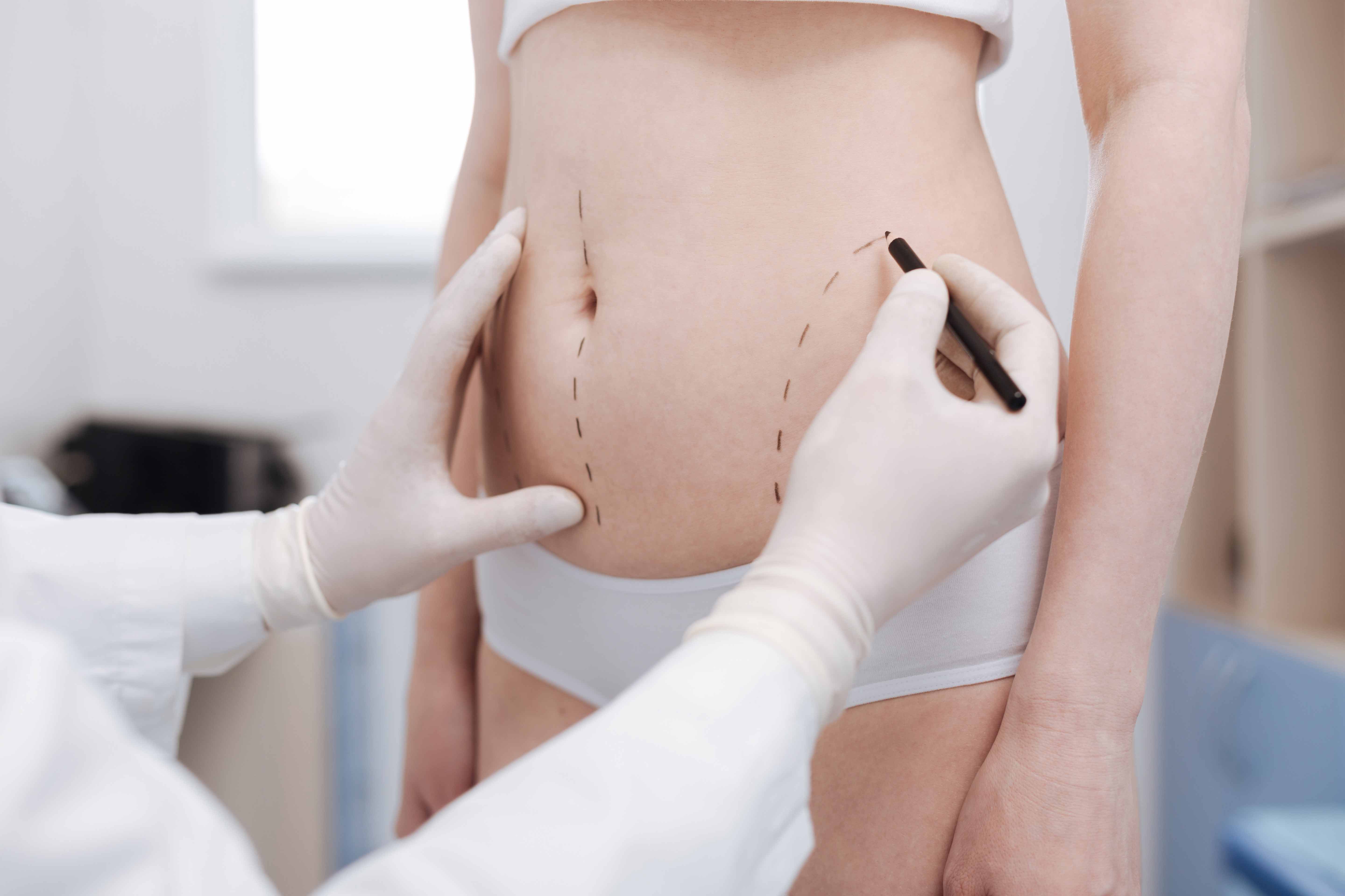 All About Liposuction – 10 Important Facts That You Should Know