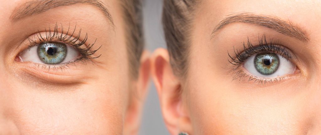 Top Seven Questions to Ask Your Surgeon Before Having Eyelid Surgery