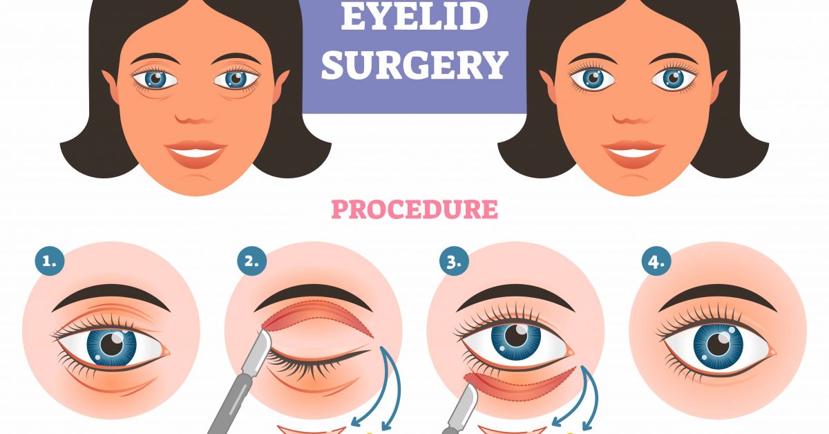 Recover Fast After Eyelid Surgery By Following Few Simple Tricks