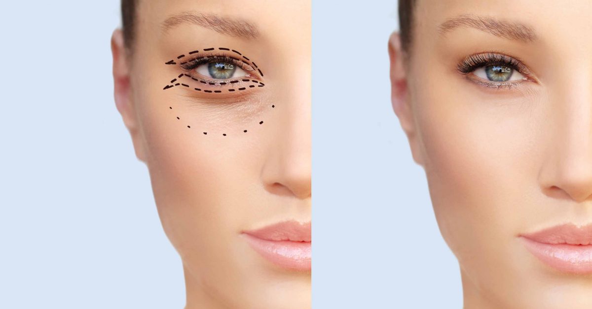 Perfect Tips Of Recovery After Going Through Blepharoplasty Surgery