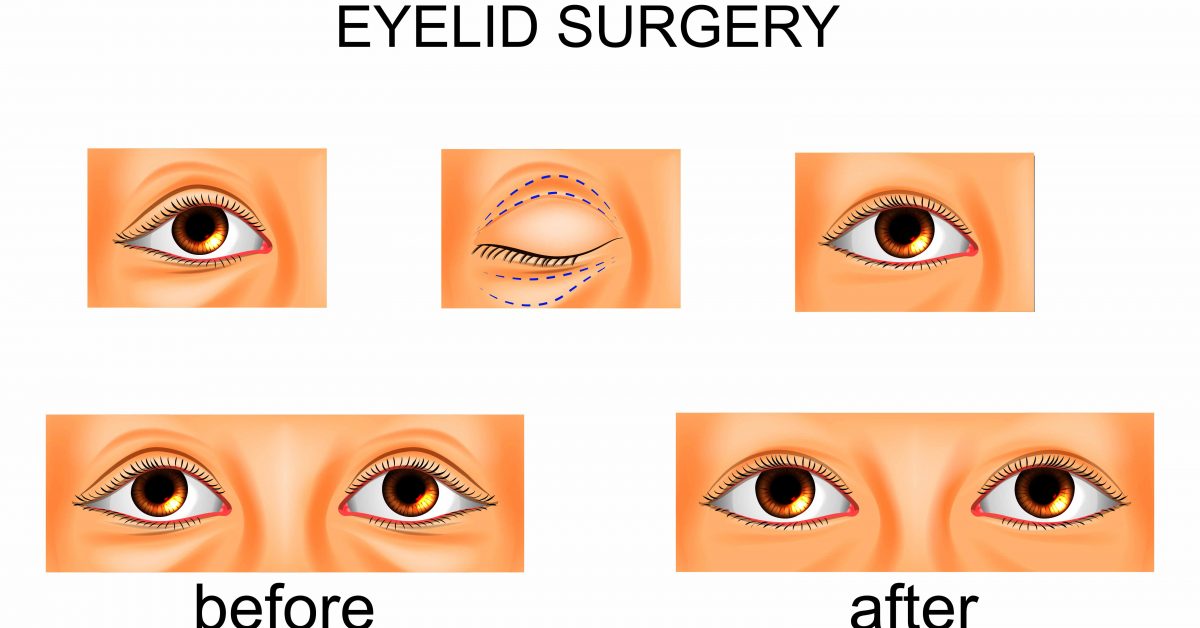 Common Eyelid Malposition After Blepharoplasty