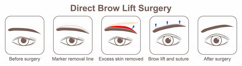 Brow-Lift-Browplasty-2