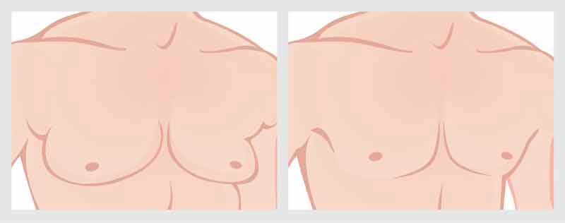 Why Is Gynecomastia on the Rise?