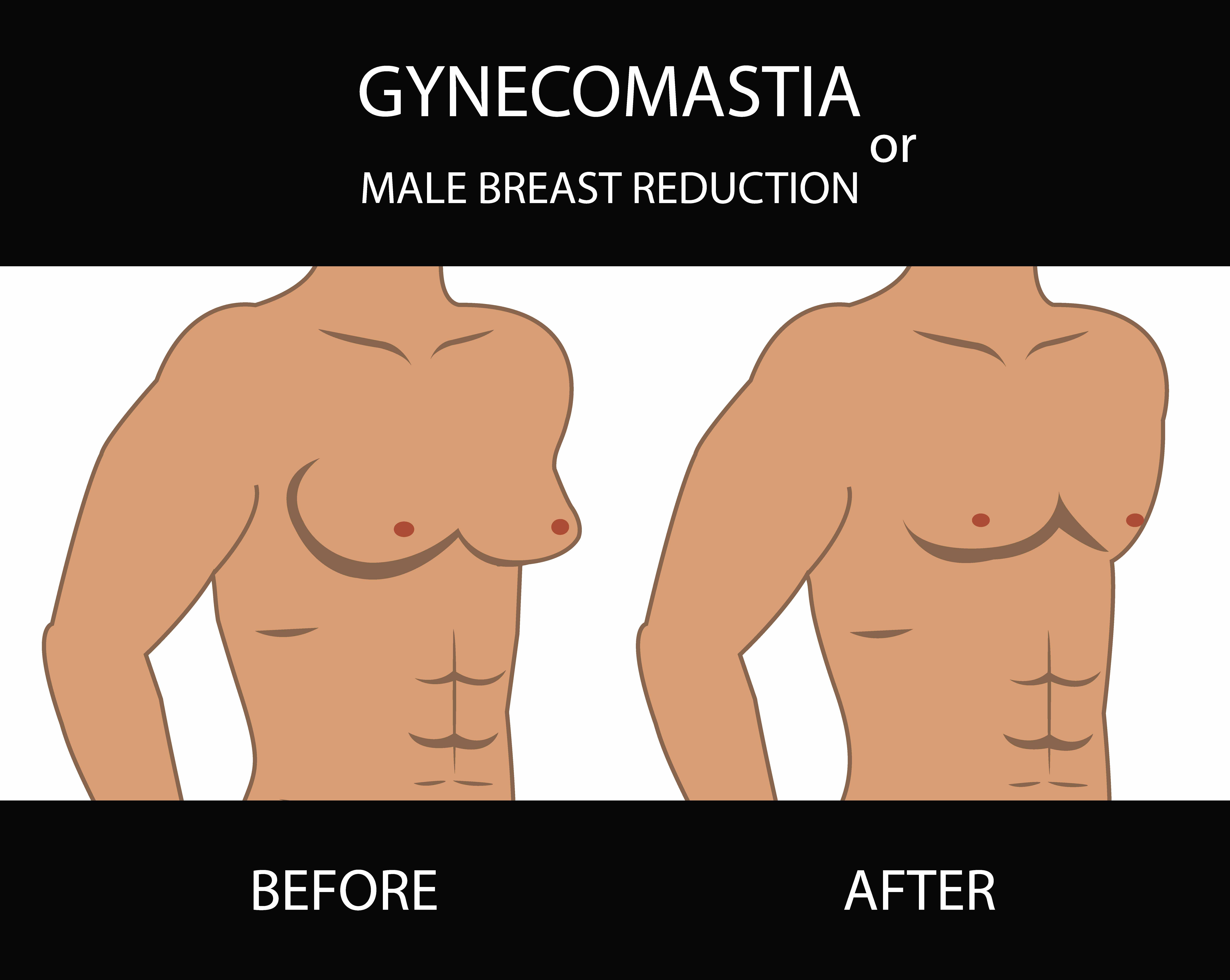 Gynecomastia: Unveiling Worth Knowing Facts