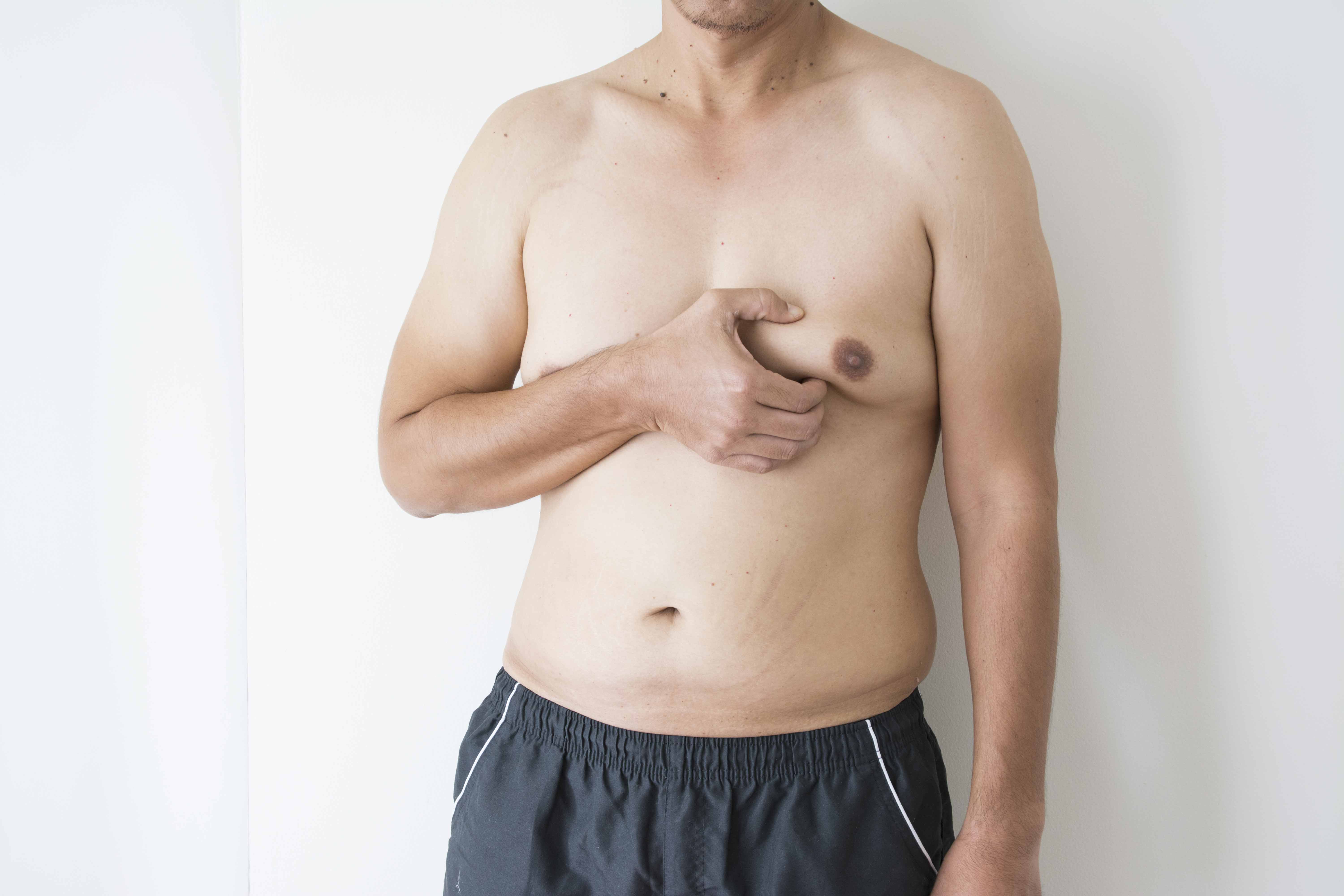 Why Is Gynecomastia on the Rise?