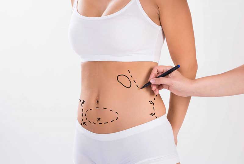 Can Fat return after Liposuction?