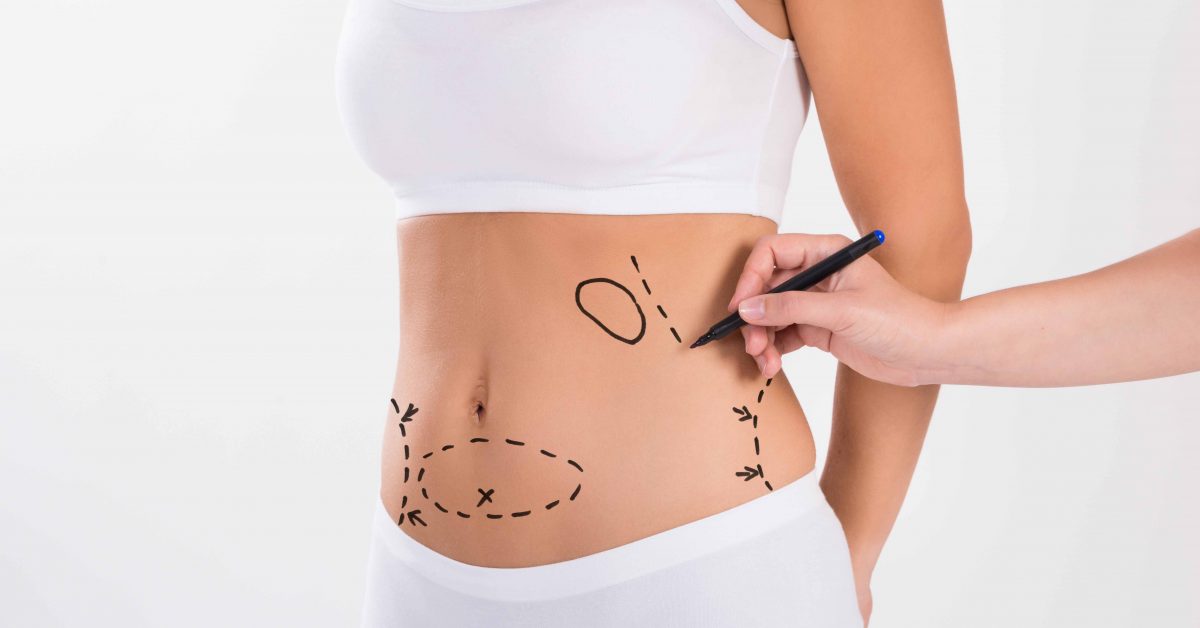 Surgical Liposuctions vs. Non-Surgical Liposuction – All You Need to Know