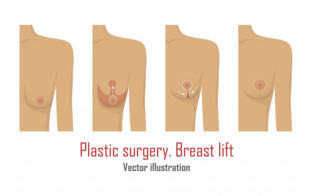 Options for Breast Lift - Everything You Need to Know