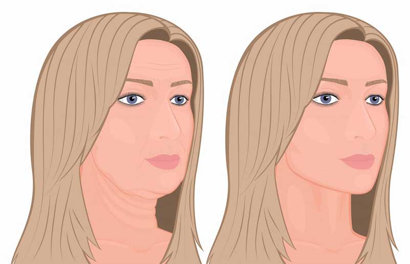 A Promising Surgery for an Ultimate Neck Transformation