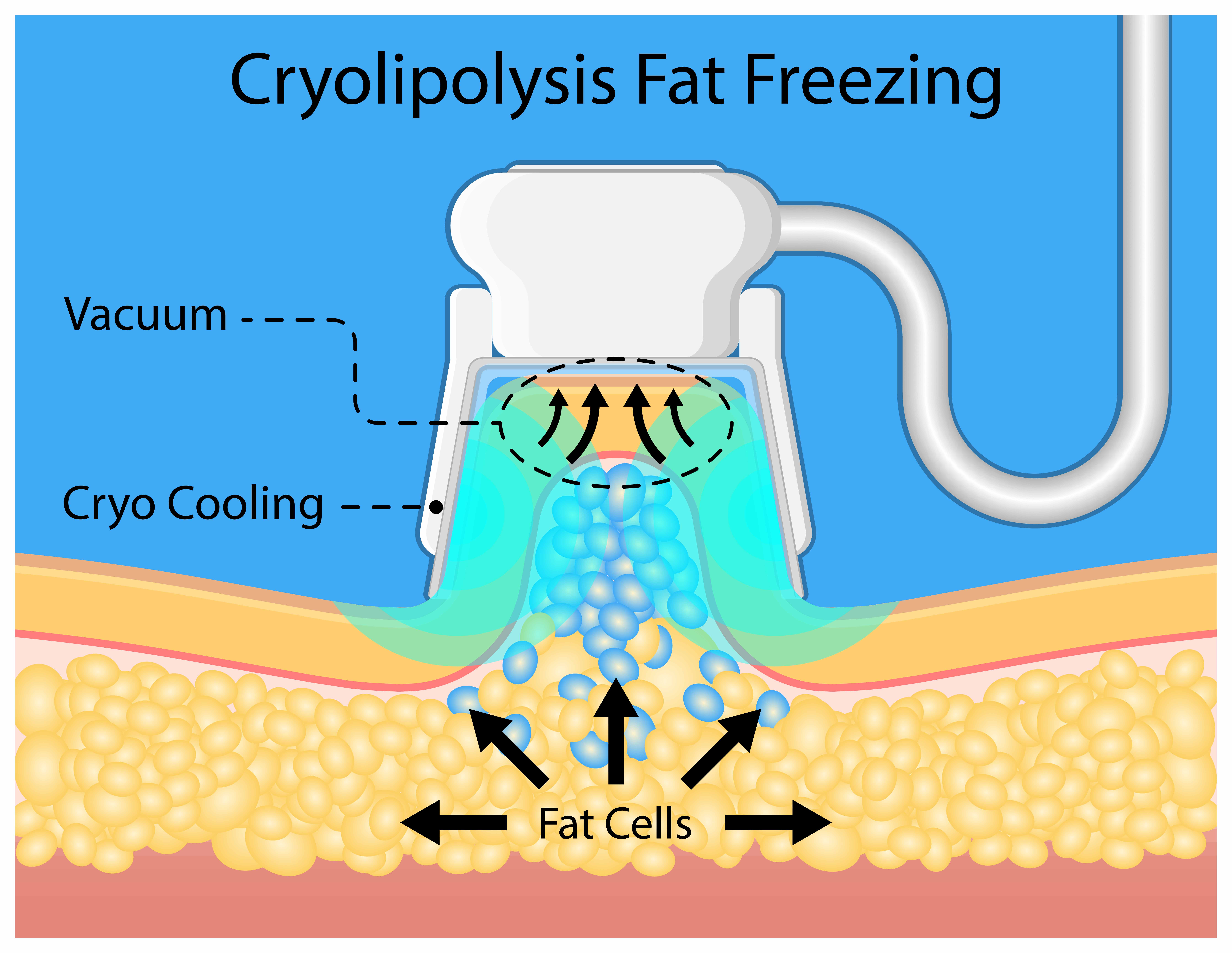 How Cool is CoolSculpting – A Deep Insight