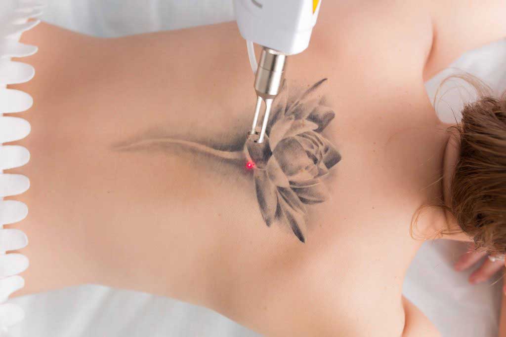 Laser Tattoo Removal by Dr. Aditi Garg Dr Aditi Garg MBBS MD Skin (DMCH)  Consultant Dermatologist: Deep Hospital, Model Town, Ludhiana ... |  Instagram
