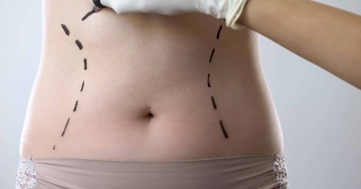 Easy Way To Recover From Tummy Tuck Using Five Simplistic Approaches