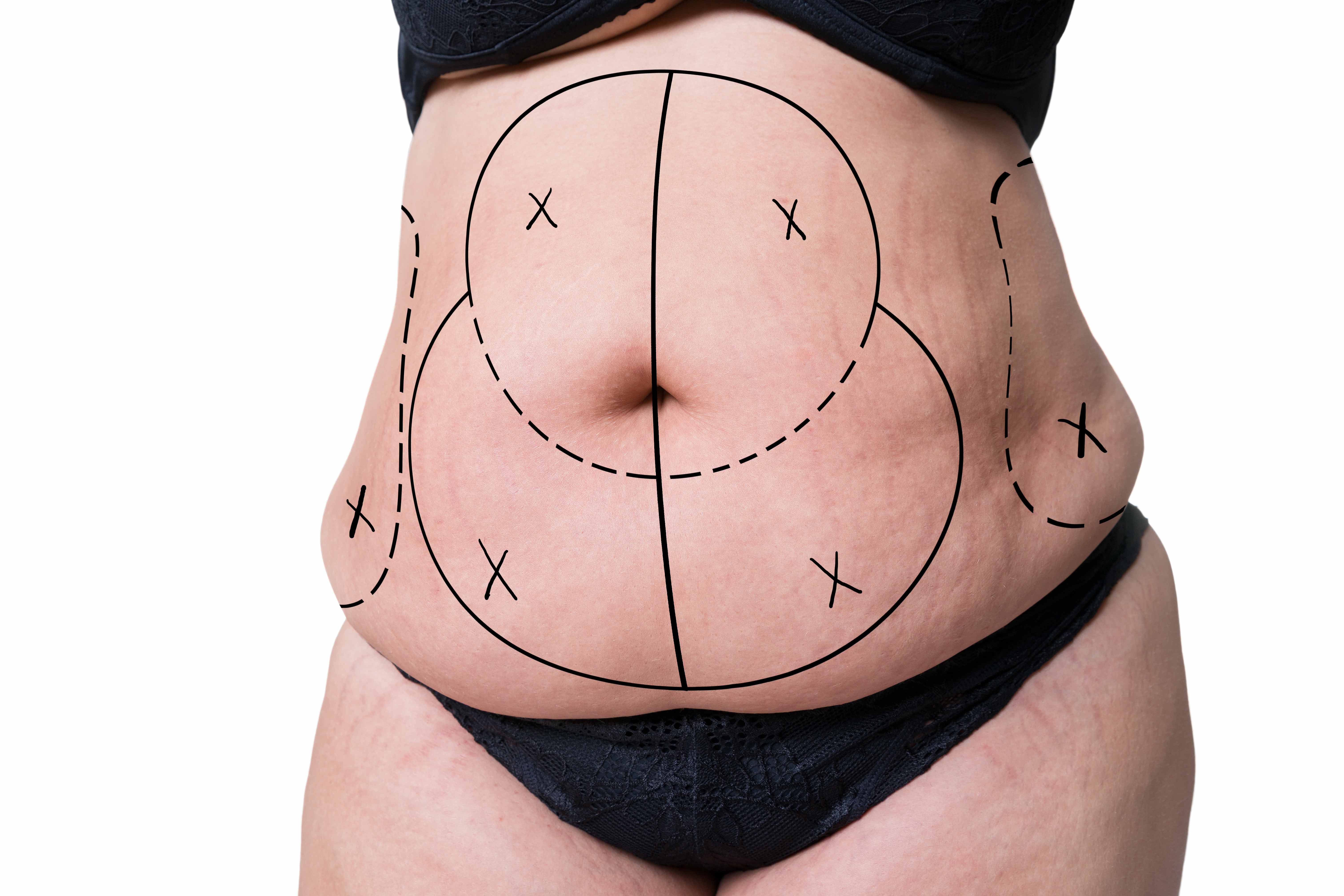 A Detailed Insight into Full Tummy Tuck Procedure