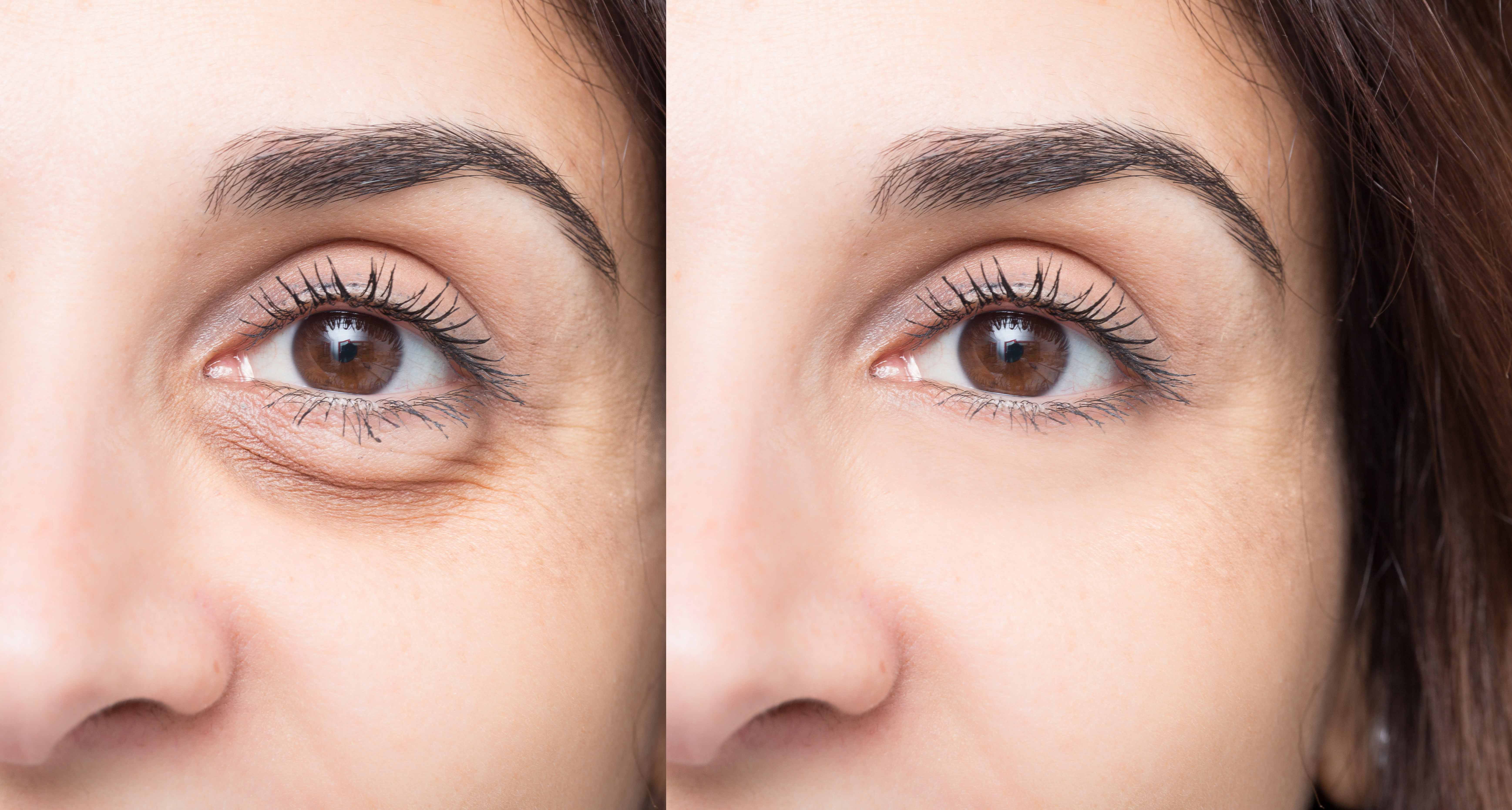 Blepharoplasty: Time to Take Off Work for the Surgery