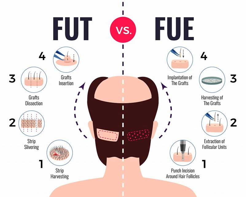 hair transplant fut vs fue