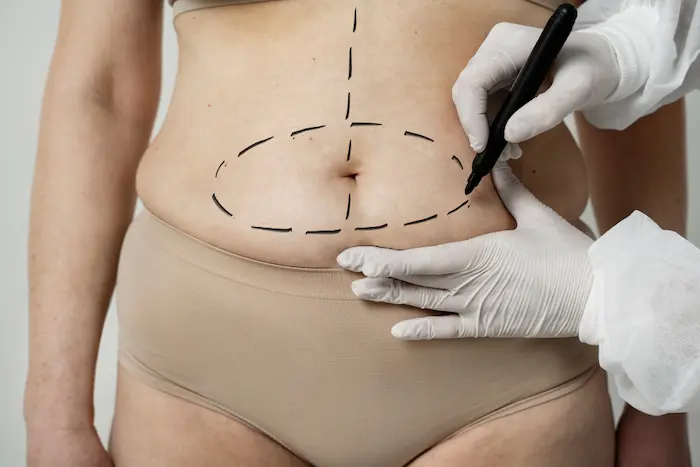 How long is the Recovery Process of a Tummy Tuck?